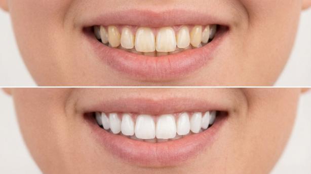 éclaircissement des dents éclaircissement des dents