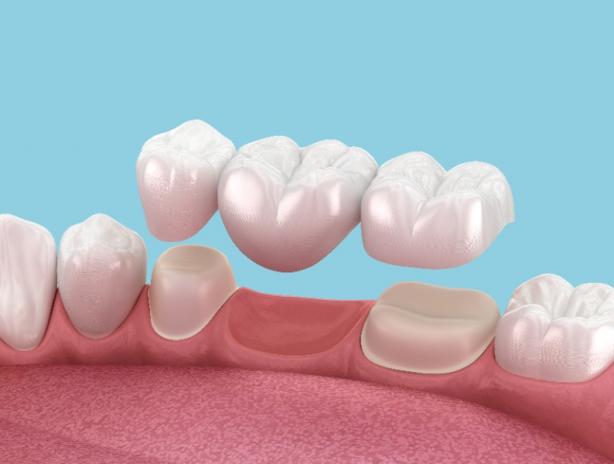 remplacement dent manquante remplacement dent manquante